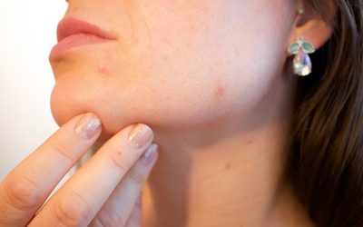How to Get Rid of Acne – The Ultimate Guide
