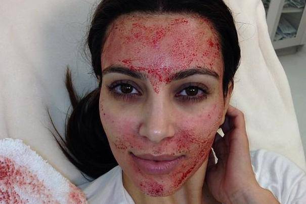 Vampire facial: What is it and why is it so popular?